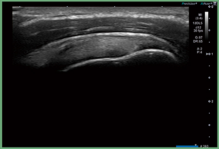 図2　高周波プローブによる肩腱板の描出
