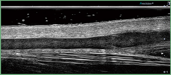 図6　超・超高周波プローブの画像例（手背の静脈）