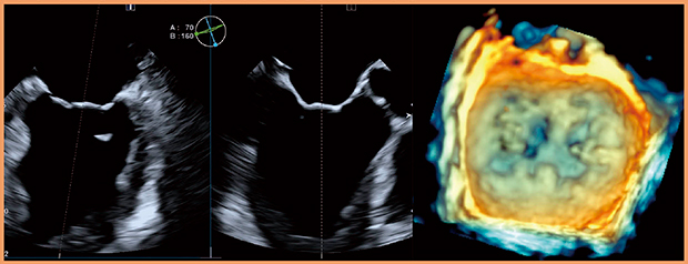 図3　PEI-512VXによる僧帽弁のマルチプレーン像および3D像 （画像ご提供：聖マリアンナ医科大学・出雲昌樹先生）