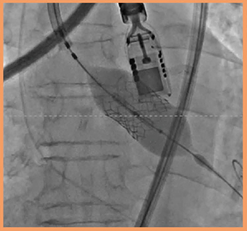 図4　TAVI中のPEI-512VXのX線像 （画像ご提供：聖マリアンナ医科大学・出雲昌樹先生）