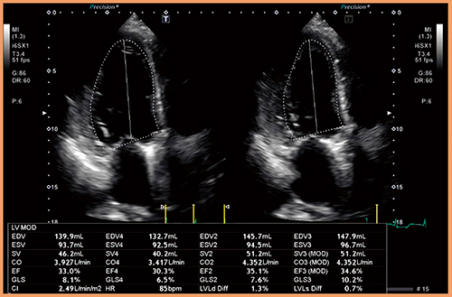 図6　Auto EF計測による左室機能評価