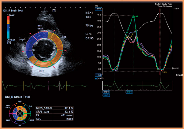 図7　2D WMTによる左室機能評価 （画像ご提供：岡山大学・高谷陽一先生，当社にて解析を実施）