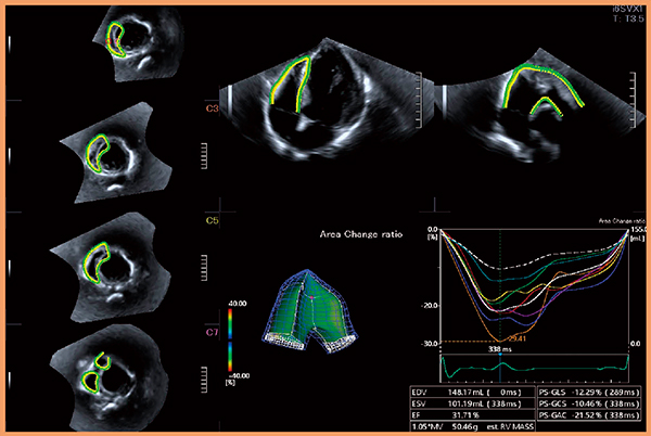 図8　3D RV Trackingによる右室機能評価 （画像ご提供：杏林大学・坂田好美先生）
