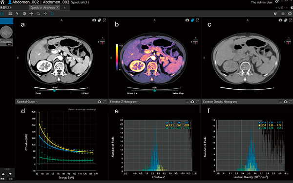 図5　Spectral Analysis（Vitrea）画面 a：仮想単純X線画像（70keV）　b：Iodine Map　c：virtual non contrust（VNC）画像 d：CT値-keV曲線　e：実効原子番号値のヒストグラム　f：電子密度値のヒストグラム