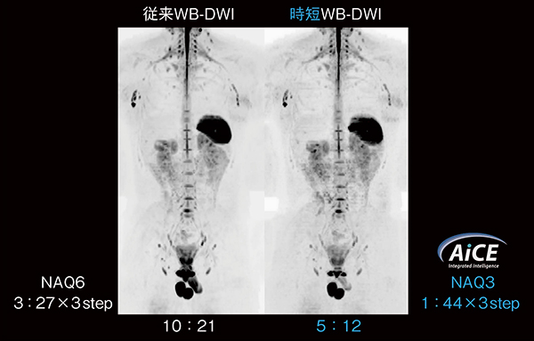図5　Vantage OrianにてAiCE併用により撮像時間を半減した例