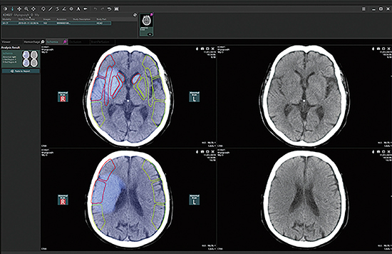 図3　AIビューワ （脳梗塞解析アプリケーションの結果表示例）