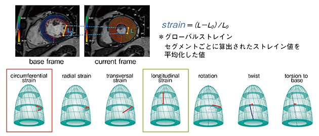 図1　心筋ストレインの概要 ストレインにはいくつか種類があり，円周方向の収縮であるcircumferential strain，長軸方向の収縮であるlongitudinal strain（LS）が，左室駆出率（LVEF）よりも心機能低下の予測因子になりうると報告されている。