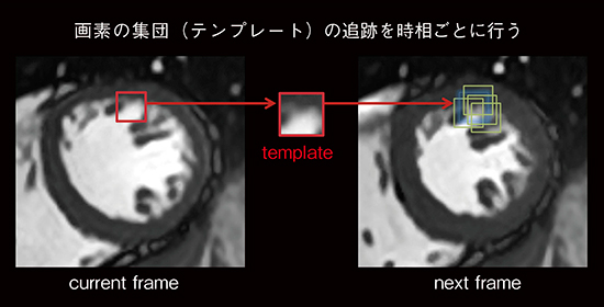 図2　高精度のtemplate matching技術 関心領域全体でテンプレートの追跡を繰り返し，フレーム間での心筋や乳頭筋の動きを追従する。