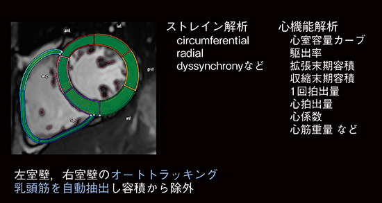図3　1クリックの自動解析 高精度な輪郭の自動検出とtemplate matching技術により，1クリックでLV/RVのCFAやストレイン解析が可能である。