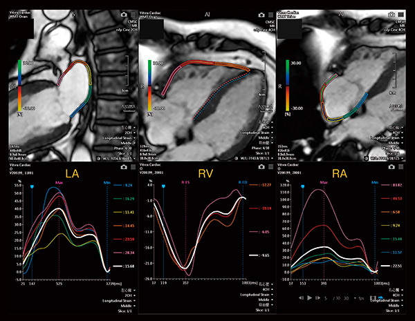 図4　LA，RV，RAのLS解析結果 長軸においても簡便な輪郭トレースが可能である。シネMRIは，患者の体格や操作者による画質のバラツキが少なく，安定した解析が可能である。