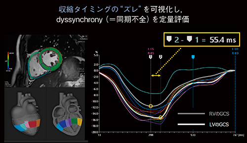 図5　Dyssynchrony analysis 任意のセグメント間における収縮タイミングのズレを可視化し，定量評価することが可能である。