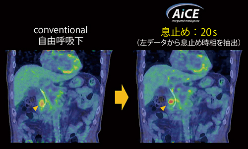 図4　短時間収集の活用例（息止めPET画像）
