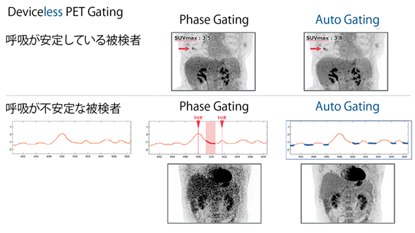 図1　Phase GatingとAuto Gatingの比較