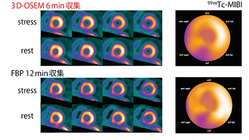 図3　3D-OSEM再構成とFBP再構成の比較 （データご提供：福島県立医科大学様）