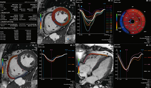 図3　VitreaでのMC-WMT LV/RVのストレイン解析例