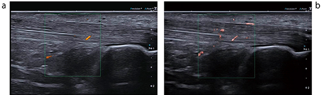 図4　アキレス腱描出におけるカラードプラ（a）とSMI（b）の比較