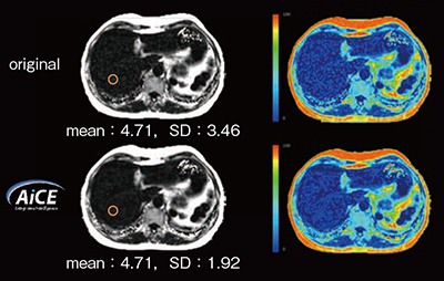 図3　FFQにAiCEを適用した症例 AiCE前後で定量値は変化せずSDが小さくなっている。