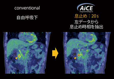図2　短時間収集の活用例（息止めPET画像）