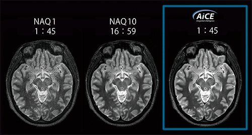 図1　AiCEのSNR向上効果により，10回加算相当の画像を1回加算の時間で取得することができる