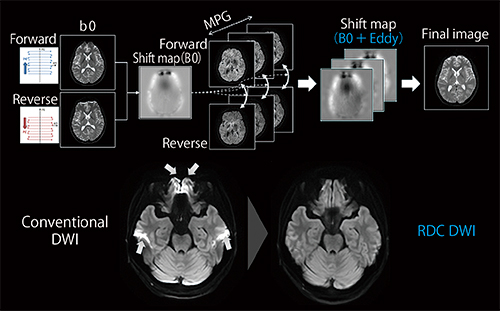 図2　RDC DWIでは，順逆両方向の位相エンコードを撮像することで歪み補正を行う