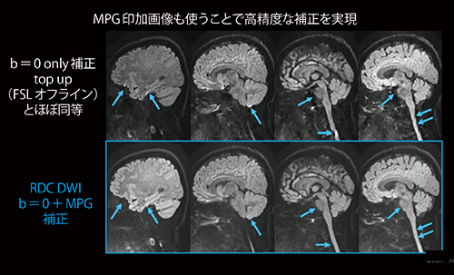 図3　RDC DWIでは，b0補正に加えて，MPG補正も行う