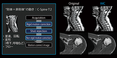 図4　IMCにより，剛体および非剛体の動きに由来するアーチファクトが低減される