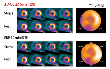 図2　3D-OSEM再構成とFBP再構成の比較 （画像ご提供：福島県立医科大学様）