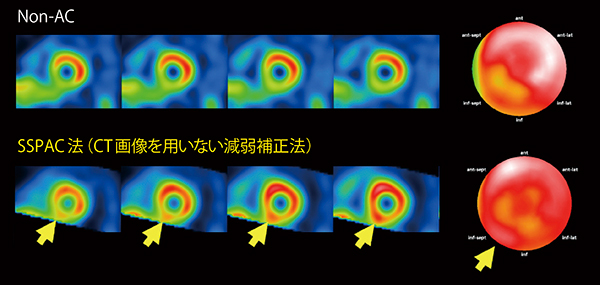 図4　123I製剤におけるNon-ACとSSPAC法による減弱補正の比較 （画像ご提供：旭川赤十字病院様）