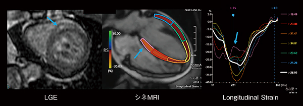 図3　COVID-19感染後心筋炎におけるストレイン解析 （画像ご提供：自治医科大学附属さいたま医療センター様）