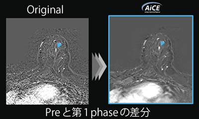 図2　生検時にAiCEを適用した例 （画像ご提供：亀田クリニック様）