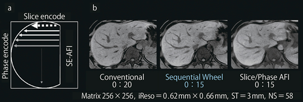 図3　呼吸停止下3D T1強調画像でSequential Wheelを適用した例 a：Sequential Wheelのk空間の充填方法の概要図 b：呼吸停止下3D T1強調撮像における各手法の比較