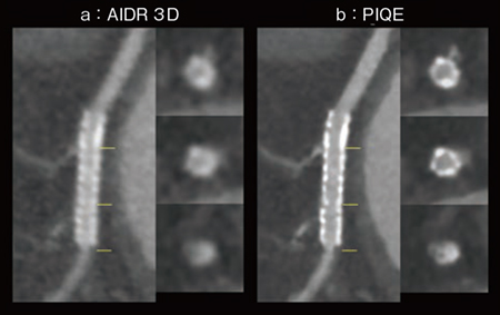 図2 冠動脈ステント症例(2.5mm径) a:AIDR 3D b:PIQE (画像ご提供:藤田医科大学病院様) 図2 冠動脈ステント症例(2.5mm径) a:AIDR 3D b:PIQE (画像ご提供:藤田医科大学病院様)