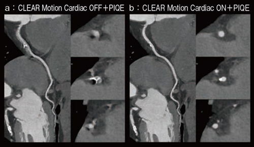 図4 冠動脈石灰化症例(HR:77) a:CLEAR Motion Cardiac OFF+PIQE b:CLEAR Motion Cardiac ON+PIQE (画像ご提供:藤田医科大学病院様) 図4 冠動脈石灰化症例(HR:77) a:CLEAR Motion Cardiac OFF+PIQE b:CLEAR Motion Cardiac ON+PIQE (画像ご提供:藤田医科大学病院様)