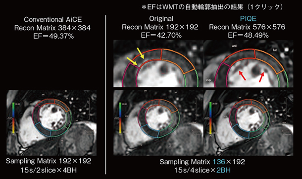 図2 Vitrea WMTによるオートストレイン解析 図2 Vitrea WMTによるオートストレイン解析