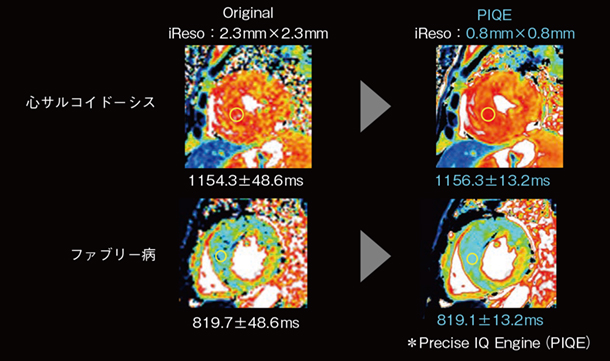 図3 Native T1map のPIQE適用臨床例 (臨床データご提供:自治医科大学附属さいたま医療センター・真鍋徳子先生) 図3 Native T1map のPIQE適用臨床例 (臨床データご提供:自治医科大学附属さいたま医療センター・真鍋徳子先生)