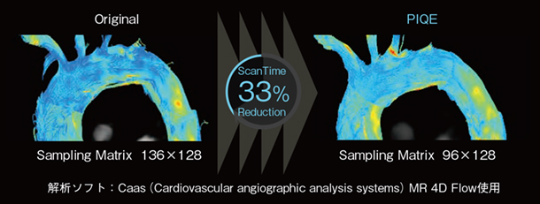図4 「Caas MR 4D Flow」(Pie Medical Imaging社)によるPIQE適用例 図4 「Caas MR 4D Flow」(Pie Medical Imaging社)によるPIQE適用例