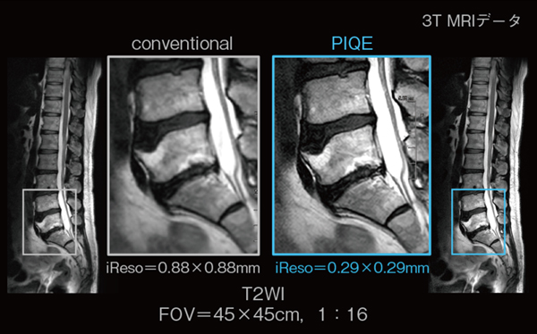 図1　広範囲撮像にPIQEを適用した例