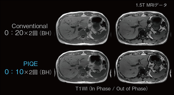 図2　PIQEによる撮像時間短縮の例
