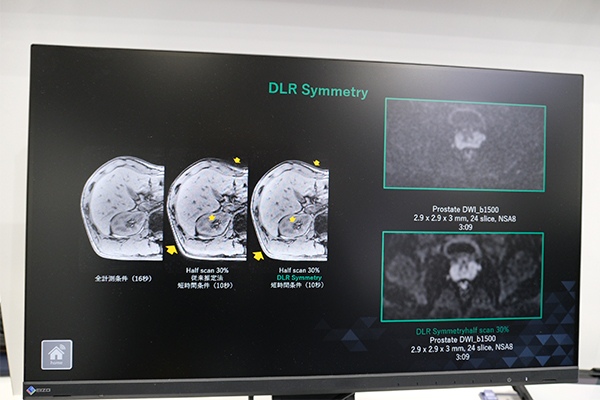 短時間で高画質を実現するハーフスキャン画像再構成技術「DLR Symmetry」