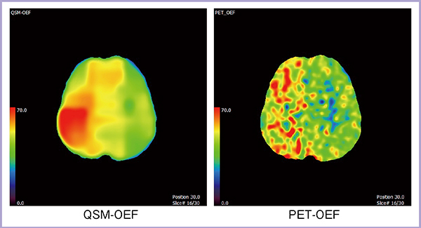 図3　QSM-OEFとPET-OEFの比較