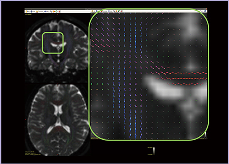 図3　MSMT-CSDに基づく拡散トラクトグラフィ