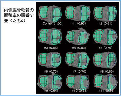 図2　OAにおける軟骨欠損の進行の予測 （参考文献4）より引用改変）