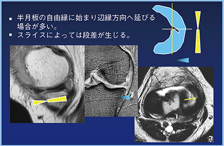 図2　放射状断裂