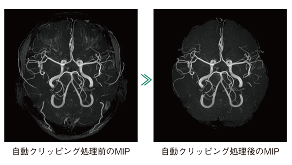 図7 AutoClipによる自動クリッピング処理前後のMIP MRA撮像終了後,自動で頭部MRAのクリッピングを実行する。自動クリッピングは,頭部の特徴量に基づいて抽出範囲を識別する。自動クリッピング処理後の画像に対し,追加のクリッピングを行うことも可能である。 図7 AutoClipによる自動クリッピング処理前後のMIP MRA撮像終了後,自動で頭部MRAのクリッピングを実行する。自動クリッピングは,頭部の特徴量に基づいて抽出範囲を識別する。自動クリッピング処理後の画像に対し,追加のクリッピングを行うことも可能である。