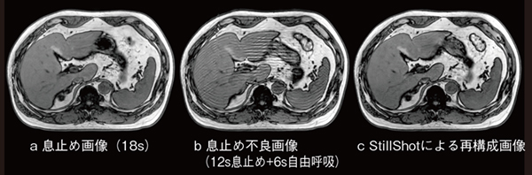 図10 息止め画像と息止め不良画像にStillShot再構成した画像 息止め不良により体動アーチファクトが発生した画像(b)を撮像後,StillShotにて画像再構成することにより,体動アーチファクトを低減した画像(c)を生成することできる。息止め画像(a)とStillShotによる再構成画像(c)に大きな差異がないことがわかる。 図10 息止め画像と息止め不良画像にStillShot再構成した画像 息止め不良により体動アーチファクトが発生した画像(b)を撮像後,StillShotにて画像再構成することにより,体動アーチファクトを低減した画像(c)を生成することできる。息止め画像(a)とStillShotによる再構成画像(c)に大きな差異がないことがわかる。