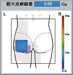 図3　下肢血管内治療（EVT）