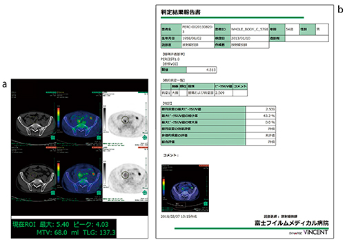 図2　オンコロジービューア画面例 a：［過去比較観察］ステージ表示例。従来は操作が煩雑であった過去比較を簡便に行えるように改良している。 b：PERCIST1.0に準拠したレポート出力例。SUVpeakに加え，SUVを除脂肪体積で補正したSULから計算したSULpeakを基に，固定された過去検査に対して増加率，減少率を計算し，標的病変評価の選択を行う。