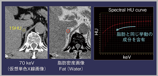 図5　症例4：右副腎腺腫