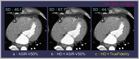 図8　冠動脈CTAにおけるHDモード＋TrueFidelity