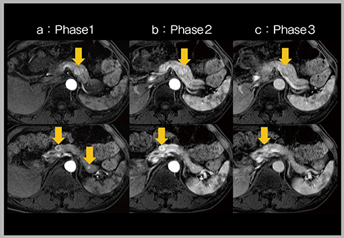 図3　高速撮像による動脈相の多時相化（RCC膵転移）（W.I.P.）